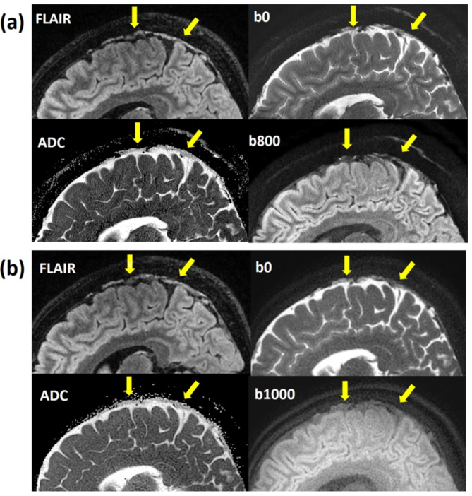MUSE and PROPELLER DWI for ADC in parasagittal dura: insights from high-resolution and reduced-distortion DWI.