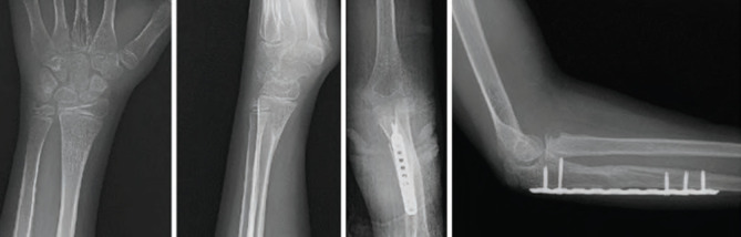 Type 1 Monteggia Equivalent Fracture with Ipsilateral Distal Radius Fracture: A Case Report.