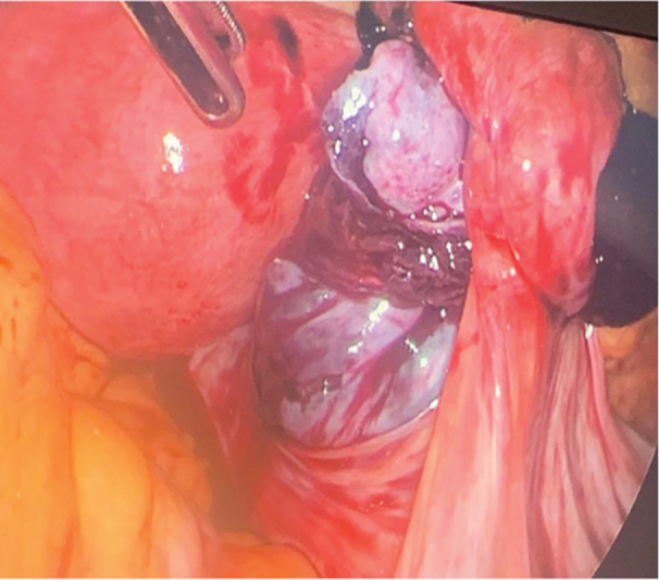 Adnexal Incarceration in a Posterior Pelvic Peritoneal Defect Associated with Ovarian Torsion: A Case Report.
