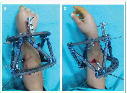 Computer-Assisted Circular External Fixator in the Treatment of Wrist and Forearm Deformities: Functional and Radiological Outcomes.