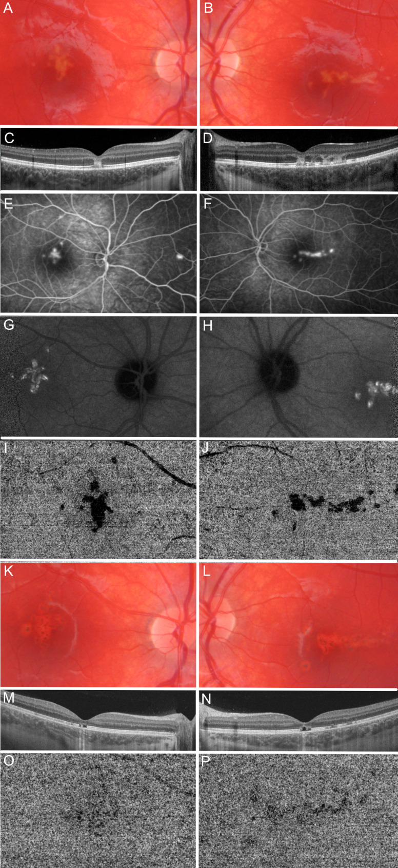 Classification of acute retinal pigmentepithelitis.