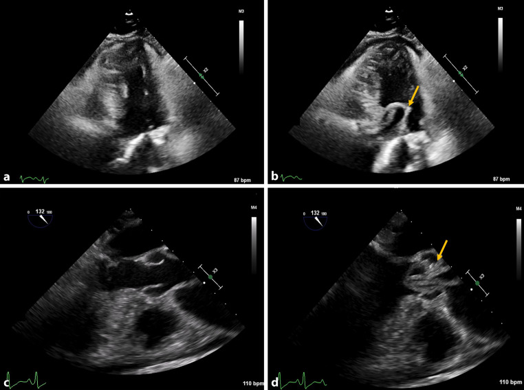 Intimointimal intussusception in acute aortic dissection: a rare phenomenon.