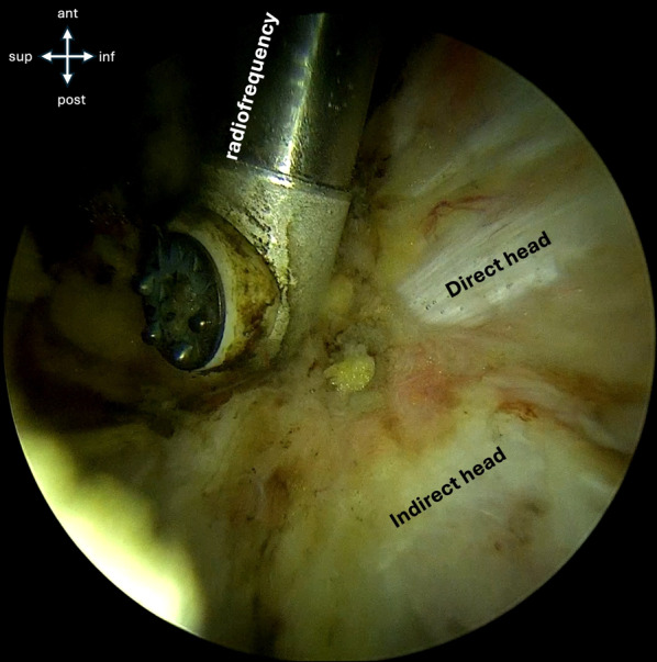 Endoscopic-assisted percutaneous fixation for displaced anterior inferior iliac spine avulsion fractures: a prospective cohort study.
