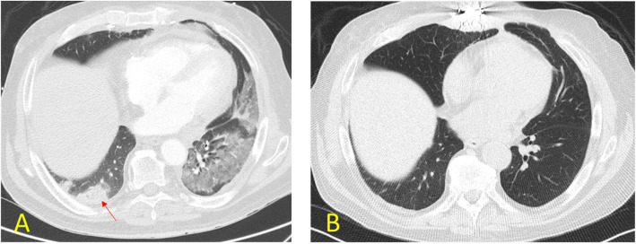 Acute pulmonary embolism treatment in lung transplant recipients: mechanical thrombectomy and catheter directed thrombolysis.