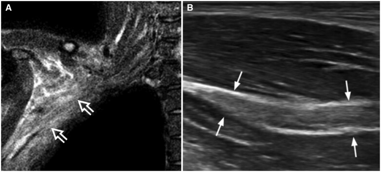 Don't be perplexed by the plexus! A practical approach to brachial plexus ultrasound.