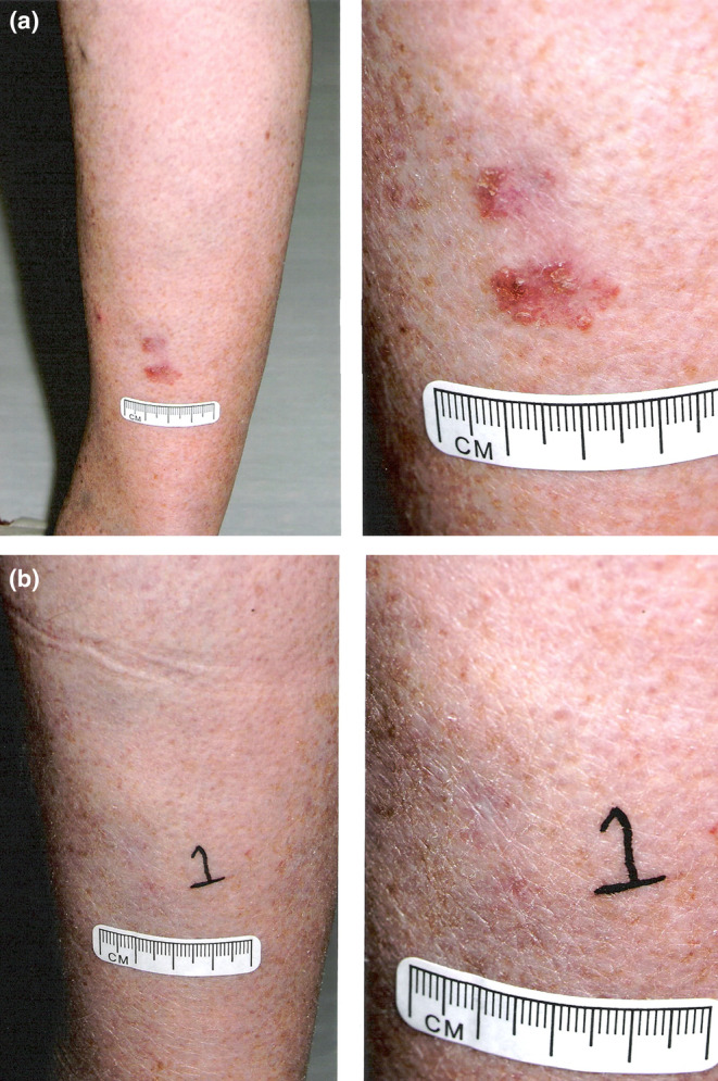 Topical Photodynamic Therapy in a Medical Centre: The Scottish Dermatology Experience.