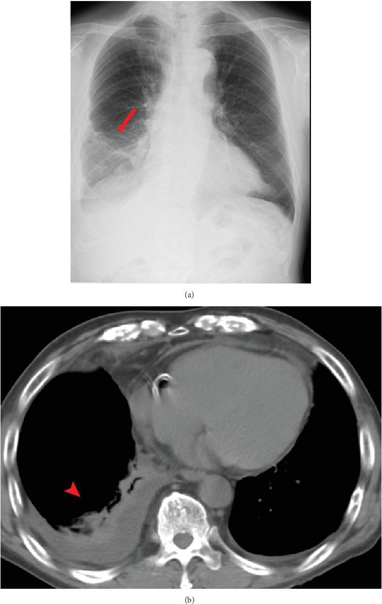Remarkable Antitumor Effects and Serious Multiple Immune-Related Adverse Events in Malignant Pleural Mesothelioma: Two Case Reports.