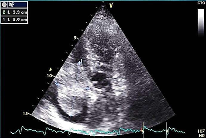Relation of giant right atrial mass and thrombocytopenia; Recovery with surgery.