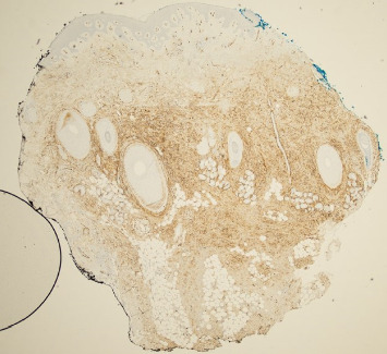 A Case of Highly Recurrent DFSP: Treatment Dilemmas and Considerations.