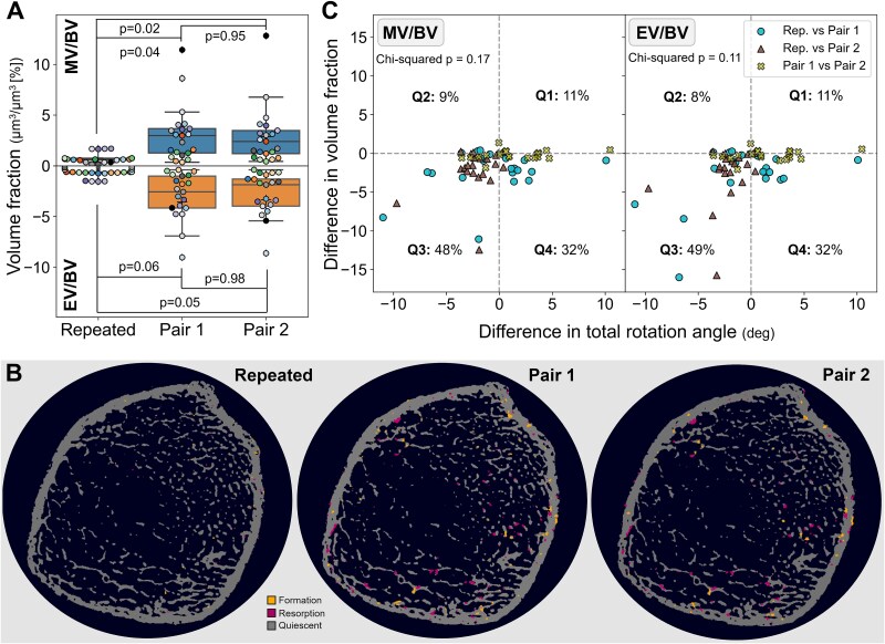 Non-invasive quantification of bone (re)modeling dynamics in adults with osteogenesis imperfecta treated with setrusumab using timelapse high-resolution peripheral-quantitative computed tomography.