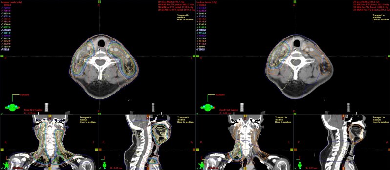 Postoperative hyperfractionated IMRT with weekly cisplatin for head and neck cancer: phase IIa trial.