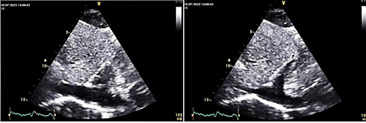 Relation of giant right atrial mass and thrombocytopenia; Recovery with surgery.