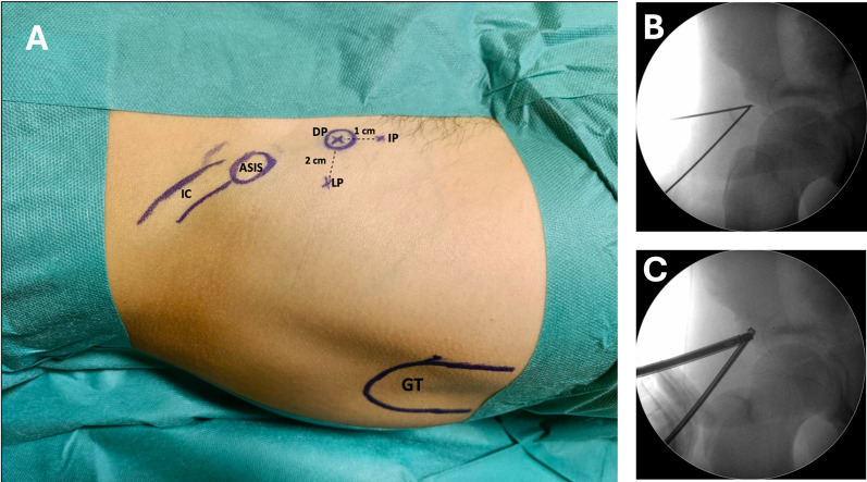 Endoscopic-assisted percutaneous fixation for displaced anterior inferior iliac spine avulsion fractures: a prospective cohort study.