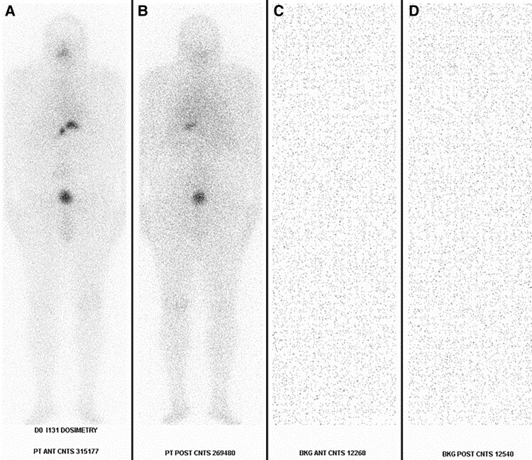 Recombinant TSH Performs as Well as Thyroid Hormone Withdrawal for Iodine-131 Therapy With Dosimetry for Thyroid Cancer.