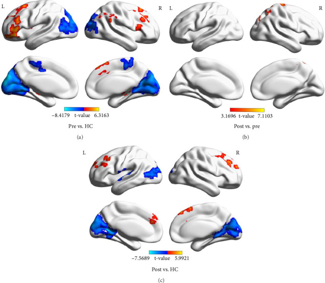 Exploring the Effects of Action Observation Therapy on Swallowing Disorders in Stroke: A Functional Connectivity-Based fMRI Study.