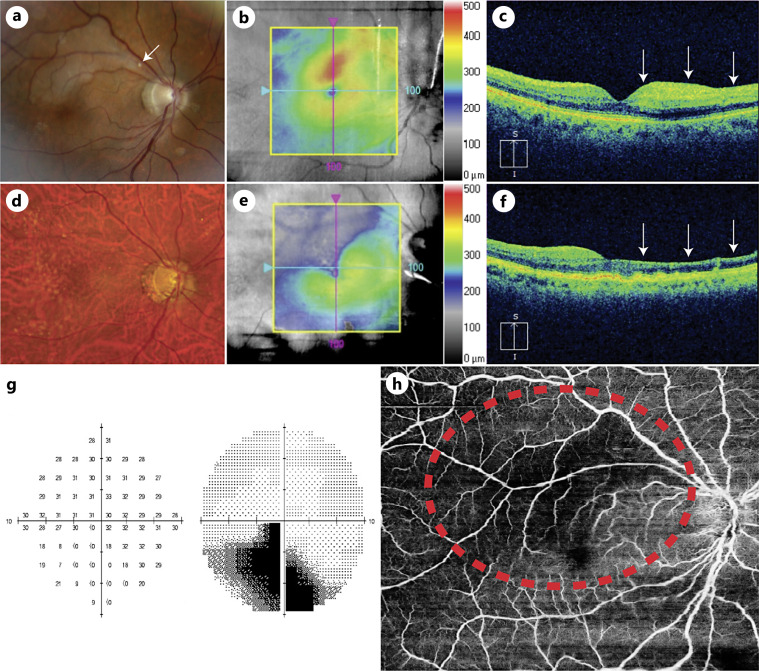 Fovea Sparing Branch Retinal Artery Occlusions Imaged with Optical Coherence Tomography Angiography: Two Case Reports.