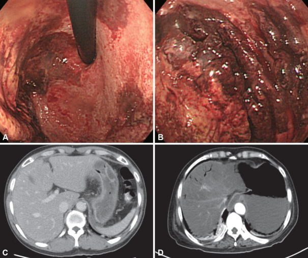 Gastric Ulcers Caused by Non-Helicobacter pylori Infections.