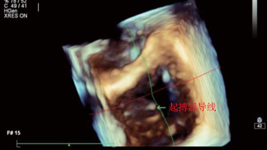 [Research of tricuspid regurgitation associated with cardiac implantable electronic devices].