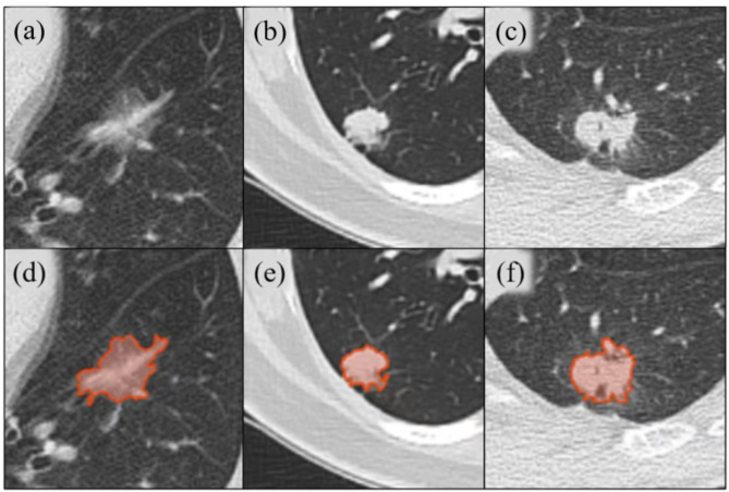Differentiating high-grade patterns and predominant subtypes for IASLC grading in invasive pulmonary adenocarcinoma using radiomics and clinical-semantic features.