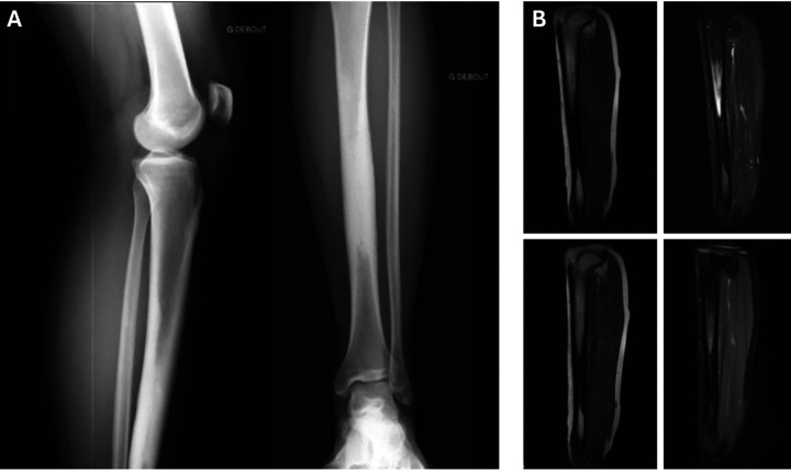 Case Report: The role of bone scans in detecting Ribbing disease.