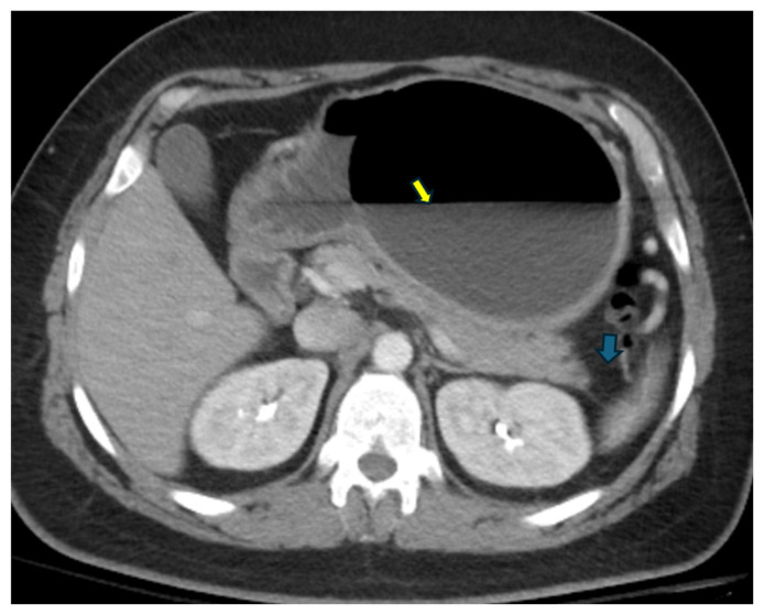 Rare Case of Intragastric Balloon Induced Acute Pancreatitis.