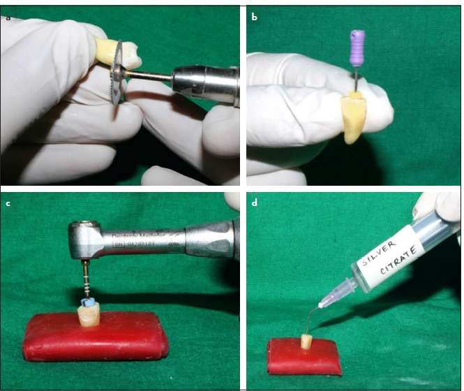 Comparative Evaluation of the Effect of EDTA, Chitosan, Etidronic Acid, and Silver Citrate on the Mineral Content of Root Canal Dentin Using Energy Dispersive X-ray Spectroscopy: An In-Vitro Study.