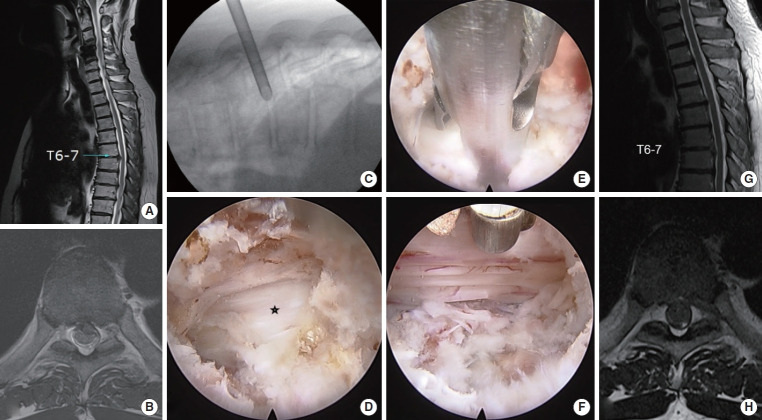 Transforaminal Endoscopic Thoracic Discectomy Is More Cost-Effective Than Microdiscectomy for Symptomatic Disc Herniations.
