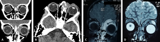 Invasive bony destructive orbital aspergillosis in an immunocompetent child: a case report.