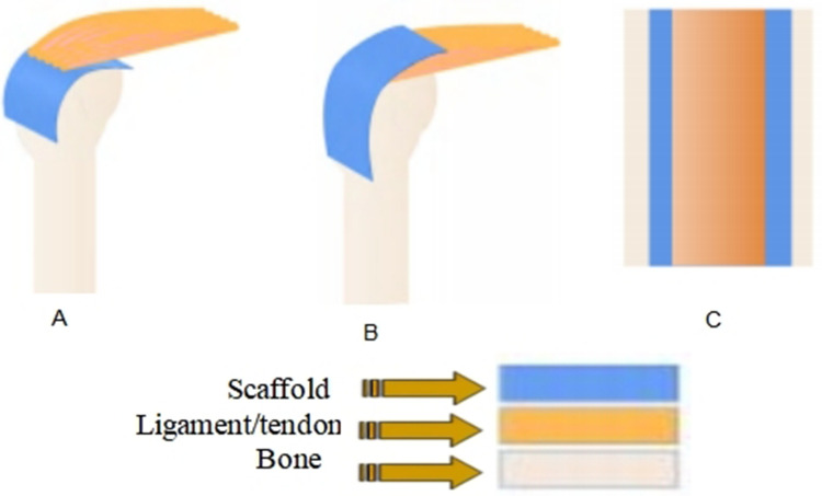 Artificial Single-Layer, Multi-Layer, and Gradient Scaffolds for Enhancing the Healing of Tendon-to-Bone Interfaces: A Mini-Review.