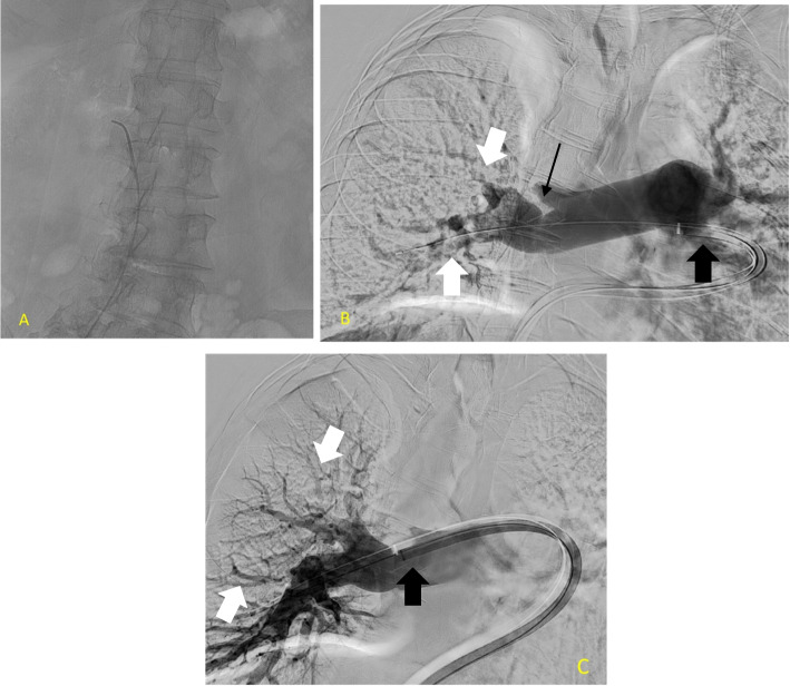 Acute pulmonary embolism treatment in lung transplant recipients: mechanical thrombectomy and catheter directed thrombolysis.