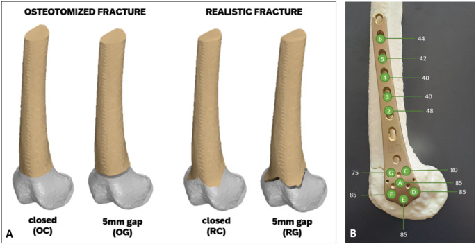 Impact of fracture morphology on the biomechanical stability of osteosynthetic fixation.