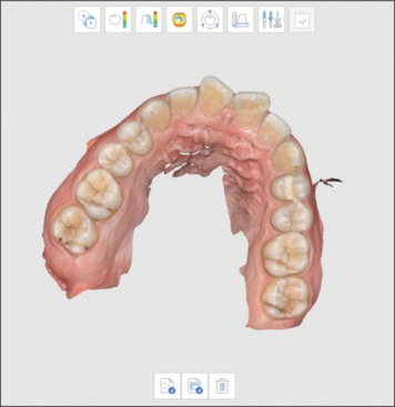 Effect of a self-ligating bracket system combined with corticision on the rate of orthodontic tooth movement: A controlled clinical trial.