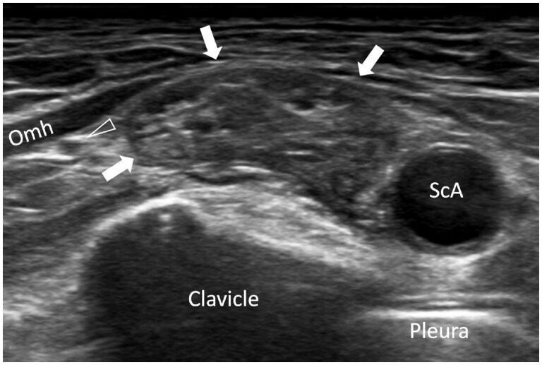 Don't be perplexed by the plexus! A practical approach to brachial plexus ultrasound.