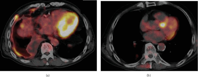 Remarkable Antitumor Effects and Serious Multiple Immune-Related Adverse Events in Malignant Pleural Mesothelioma: Two Case Reports.