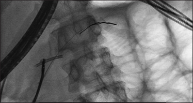 Endoscopic removal of proximally migrated pancreatic duct stents: a case series and literature review.