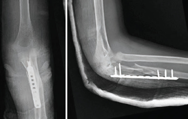 Type 1 Monteggia Equivalent Fracture with Ipsilateral Distal Radius Fracture: A Case Report.