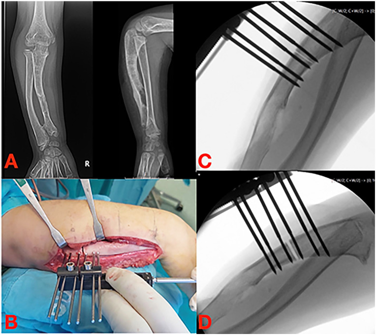 External fixators and lengthening systems in pediatric upper limb.