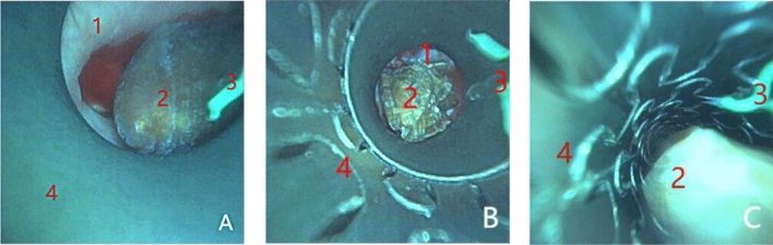 Analysis of the effectiveness and safety of 7.5 Fr ultra-thin flexible ureteroscope combined with a tip-flexible suctioning ureteral access sheath for the treatment of kidney stones.