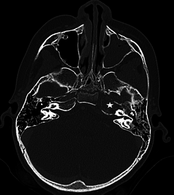 Skull Base Rhabdomyosarcoma Mimicking Osteomyelitis in a Pediatric Patient.