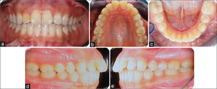 Effect of a self-ligating bracket system combined with corticision on the rate of orthodontic tooth movement: A controlled clinical trial.