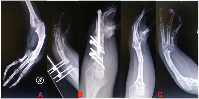 External fixators and lengthening systems in pediatric upper limb.