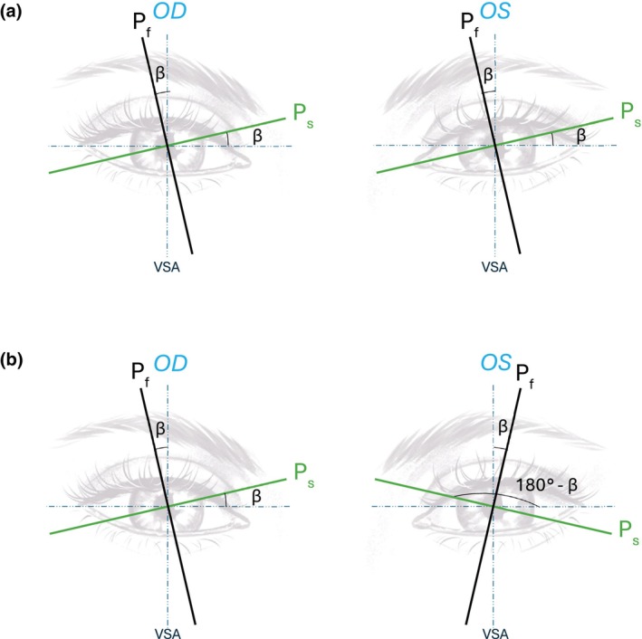 Prevalence of interocular symmetry in corneal astigmatism and the possible influence of age, sex and refractive error.