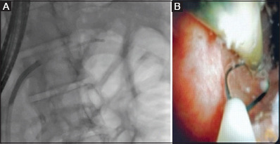 Endoscopic removal of proximally migrated pancreatic duct stents: a case series and literature review.