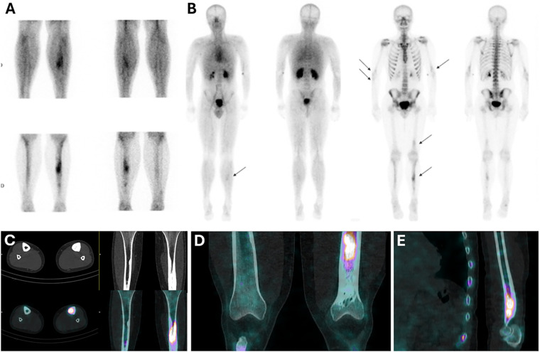 Case Report: The role of bone scans in detecting Ribbing disease.
