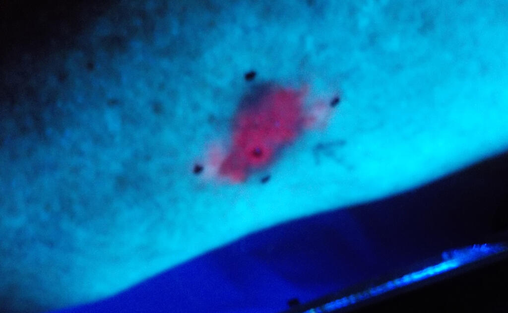 Topical Photodynamic Therapy in a Medical Centre: The Scottish Dermatology Experience.