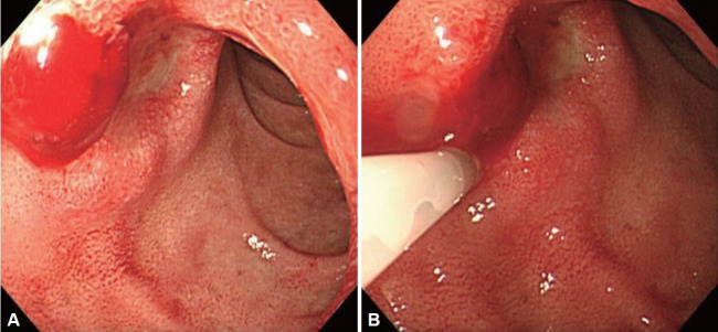 A Rare Complication of Endoscopic Epinephrine Injection Therapy for Duodenal Ulcer Bleeding.
