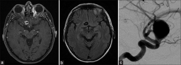 Delayed destabilization and rupture of a giant anterior circulation aneurysm following flow-diverter placement: A case report.