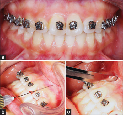 Effect of a self-ligating bracket system combined with corticision on the rate of orthodontic tooth movement: A controlled clinical trial.