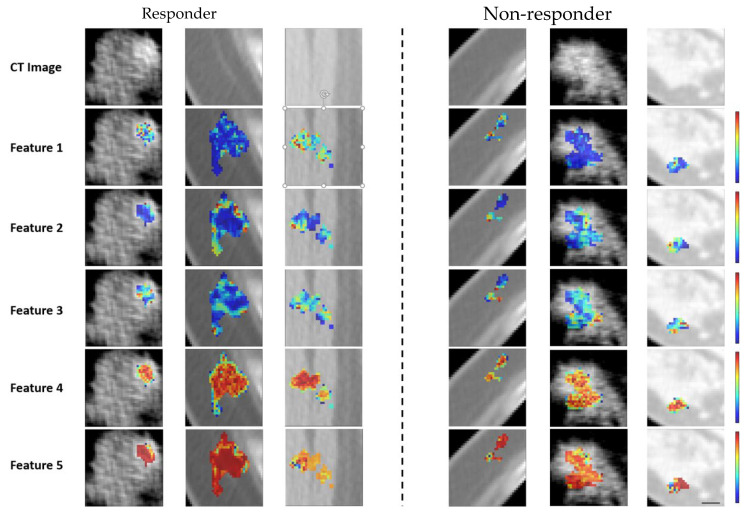 Prediction of Chemotherapy Response in Locally Advanced Breast Cancer Patients at Pre-Treatment Using CT Textural Features and Machine Learning: Comparison of Feature Selection Methods.