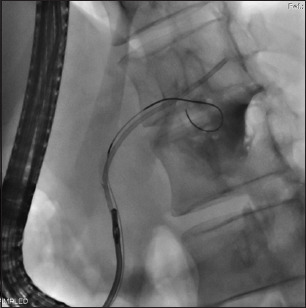 Endoscopic removal of proximally migrated pancreatic duct stents: a case series and literature review.